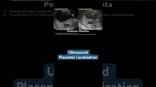 Ultrasound placental localization ultrasound doctor mbbs pregancyultrasound baby [upl. by Halla]