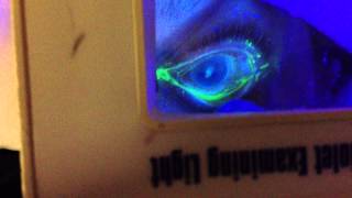 Fluorescein Staining of an Eye [upl. by Nylaehs]