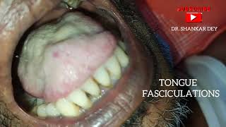 Tongue Fasciculations  Motor Neuron Disease  Amyotrophic Lateral Sclerosis  Dr Shankar Dey [upl. by Aneeuqal]