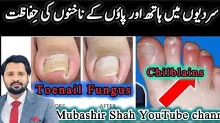 Miracle Treatment For Toenail Fungus amp Chilblains  سردیوں میں ہاتھ اور پاؤں کی انفیکشن سے حفاظت [upl. by Ailhad928]