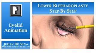 Blepharoplasty Animation – How is Lower Blepharoplasty Eyelid Surgery completed [upl. by Aehc146]