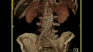 Aortic Stent Graft 3D imaging of a vascular stent in satisfactory position [upl. by Accalia]