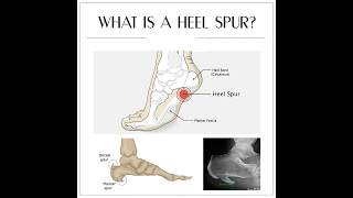 Heel spur  Calcaneal spur [upl. by Elmore]