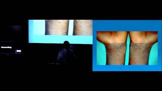 Dermatology in Africa Emphasis on HIV related skin problems [upl. by Annoel]