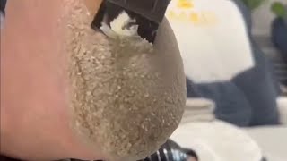 Pedicure video33，scales on the heel，vertical plantaris，plantar wart [upl. by Edin]