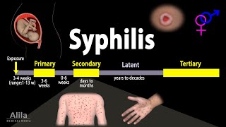 Syphilis  Pathophysiology Diagnosis and Treatments Animation [upl. by Aisined]