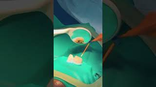 Root canal filling  Obturación BIOC Sealer [upl. by Seibold]