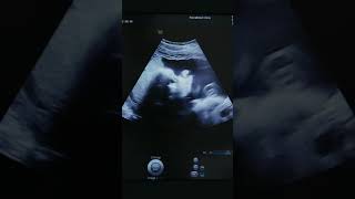 Ultrasonography  Medical ultrasound includes diagnostic imaging techniques  Digital Technologys [upl. by Halsted]