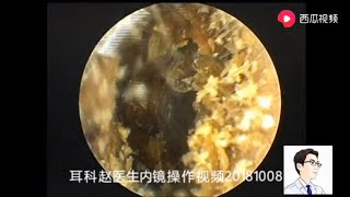 Ear wax removal Bilateral external auditory canal cholesteatoma 8 minutes 双侧外耳道胆脂瘤，8分钟 [upl. by Marney]