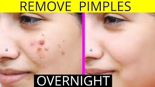 How To Remove Pimples Overnight  Acne Treatment  Anaysa [upl. by Ladiv]