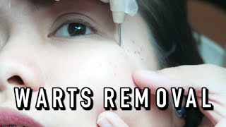 WARTS REMOVAL LETS FACE IT  VLOG [upl. by Einaeg352]