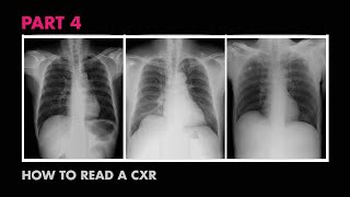 Assessment of CXR Positioning amp Views  How to Read a Chest XRay Part 4  MEDZCOOL [upl. by Aihsia881]