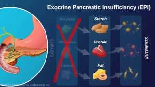 Exocrine Pancreatic Insufficiency [upl. by Collie]