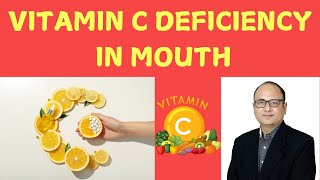 VITAMIN C DEFICIENCY IN MOUTH [upl. by Itak278]