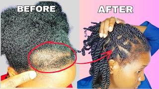 She Grew Back Her Receding Hairline In 10 Days  Bald Spots And Bald Edges Gone With One Product [upl. by Garry161]