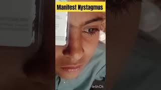 manifest Nystagmus  nystagmus eyediseases [upl. by Boyce440]