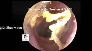 Satisfying Ear Wax Removal With Dr Zhao Video 20211028 [upl. by Sauls233]