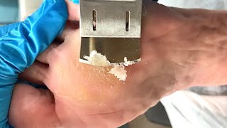 Callus removal from feetampFoot scraping dead skin【Xiao Yan pedicure】stress 39 [upl. by Aliza]