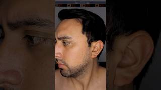 Resultados después de usar minoxidil por 3 meses 22 [upl. by Fonda]