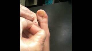 Draining a Subungual blister of toenail [upl. by Gnoht660]