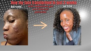 How my skin transformed in just 3 weeks of using adapalene gel and Benzoyl peroxide [upl. by Huskamp]