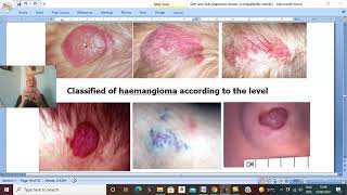 Skin and subcutaneous tissues in Arabic 8 Haemangioma  by Dr Wahdan [upl. by Gilbye]