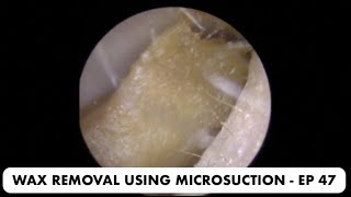 EAR WAX REMOVAL USING MICROSUCTION  EP 47 [upl. by Ysied]