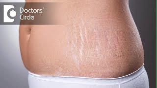 Laser treatments for stretch marks after delivery  Dr K Prem Anand [upl. by Youngman]