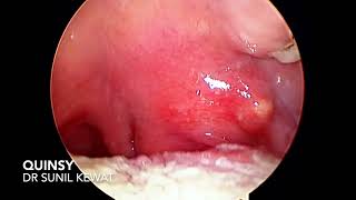 Quinsy  Peritonsillar Abscess  Dr Sunil Kewat [upl. by Mixam]