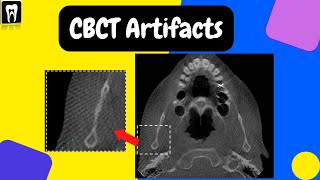 CBCT Artifacts  Basic CBCT CBCT basic understanding  Cone beam computed tomography [upl. by Kutzenco]