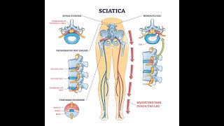 Ryggsmerter og spinal stenose [upl. by Silloc953]