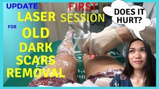 Laser Old Dark Scars Removal First SessionDoes it hurt How Much does laser Cost  Part 4 [upl. by Hoagland959]