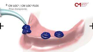 CM LOC Ancrage pour implants dentaires [upl. by Nestor117]