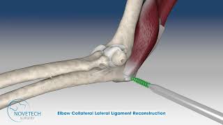 Elbow Collateral Lateral Ligament Reconstruction with NOVALIG® [upl. by Eylatan]