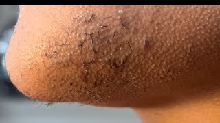 INGROWN HAIR REMOVAL 104  Plucking the hairs on my chinny chin chin [upl. by Ailemac]