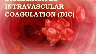 Disseminated Intravascular Coagulation [upl. by Claudia499]