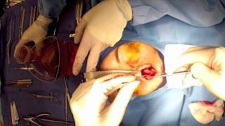 quotOpenquot Rhinoplasty Part 6 Narrowing nasal tip cartilages Cephalic Trim  Maryland Virginia [upl. by Etam]