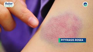 Dr Srinivasa Munivenkatappa talks about Pityriasis Rosea [upl. by Muffin824]