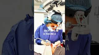 Resultados de rinoplastia ultrasónica 2 meses después [upl. by Lhary132]