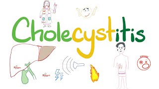 Cholecystitis  A Tale of One Cholelith  The most COMPREHENSIVE Review [upl. by Kcirded]