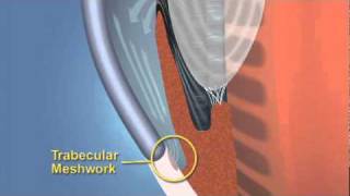 Closed Angle Glaucoma [upl. by Soalokcin442]