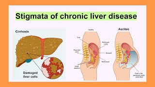 stigmata of chronic liver disease [upl. by Vivien]