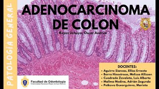 ADENOCARCINOMA DE COLON INTRODUCCIÓN PÓLIPOS Y VÍA SUPRESORA [upl. by Schoening]