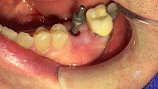 FLAPLESS IMPLANT Implante dental con una técnica sin colgajo [upl. by Napra]