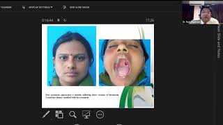 The versatility of Bleomycin the wonder by Dr Rajiv Agarwal Plastic Surgery and Burns SGPGIMS [upl. by Ynove628]