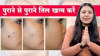 चेहरे के तिल बिना लेज़र या सर्जरी के कैसे ख़त्म करें  Remedies For Mole Removal  Upasana Ki Duniya [upl. by Assil]