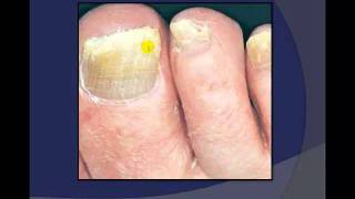 Toenail Debridement by a Podiatrist [upl. by Eylhsa282]