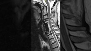 Pinched Nerve in Neck Surgery Mindys Story spinesurgery [upl. by Salokkin]