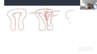 Mullerian Anomalies 2D and 3D Diagnosis By DrRaju Giraddi [upl. by Stallworth]