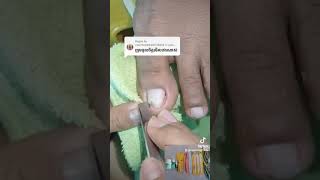 Extremely comfortable toenail treatment nail​​​ asmr fyp ear shorts viral wax [upl. by Keever320]